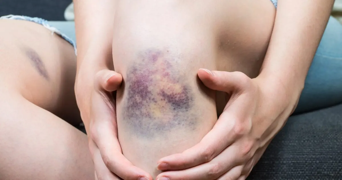Knee with bruise