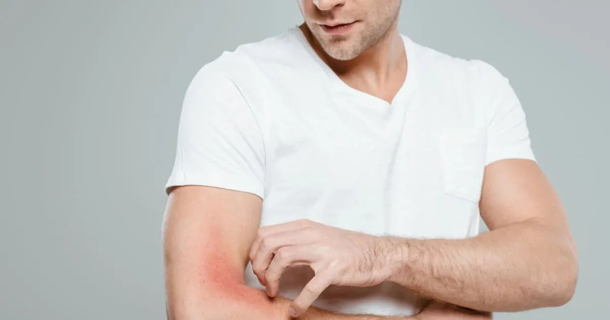Man scratching a rash on arm