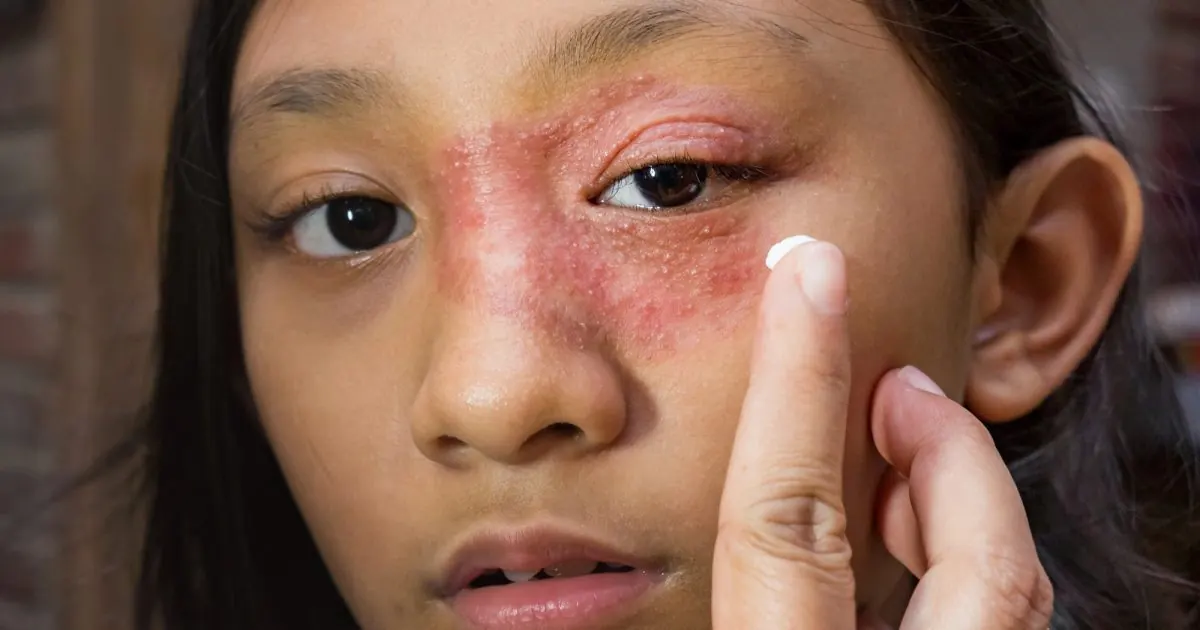 Young woman with a red, inflamed skin rash around her eye